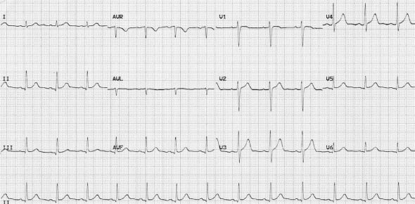 What Do You Understand By Sinus Rhythm Flashcards